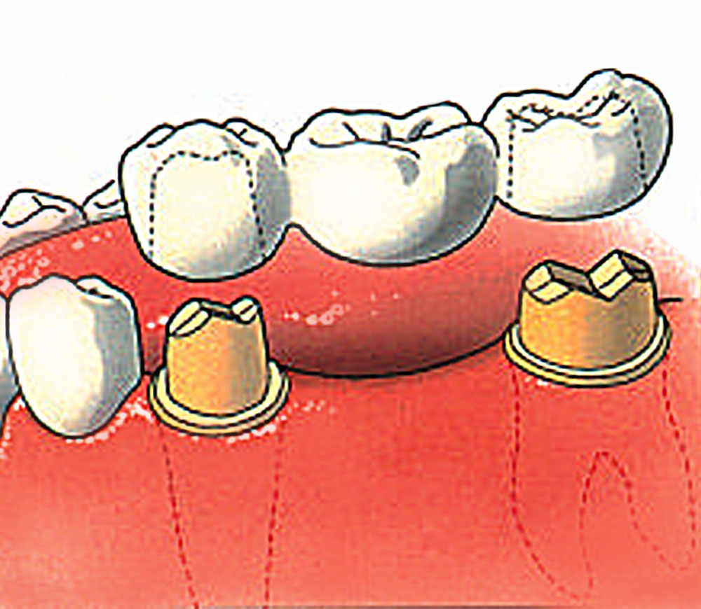 bruggen voor tanden in kortrijk