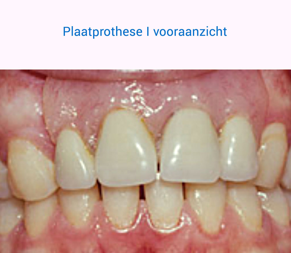 Plaatprothese van voren