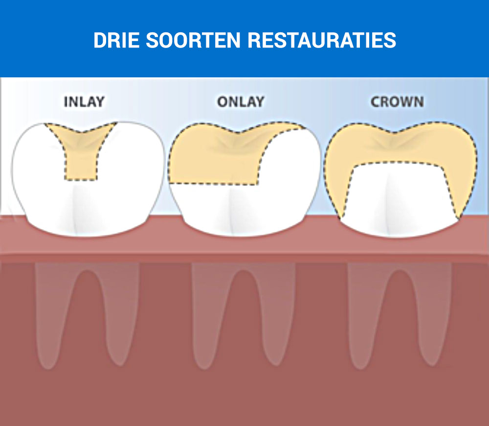 Inlays, onlays - en kronen voor op de tanden