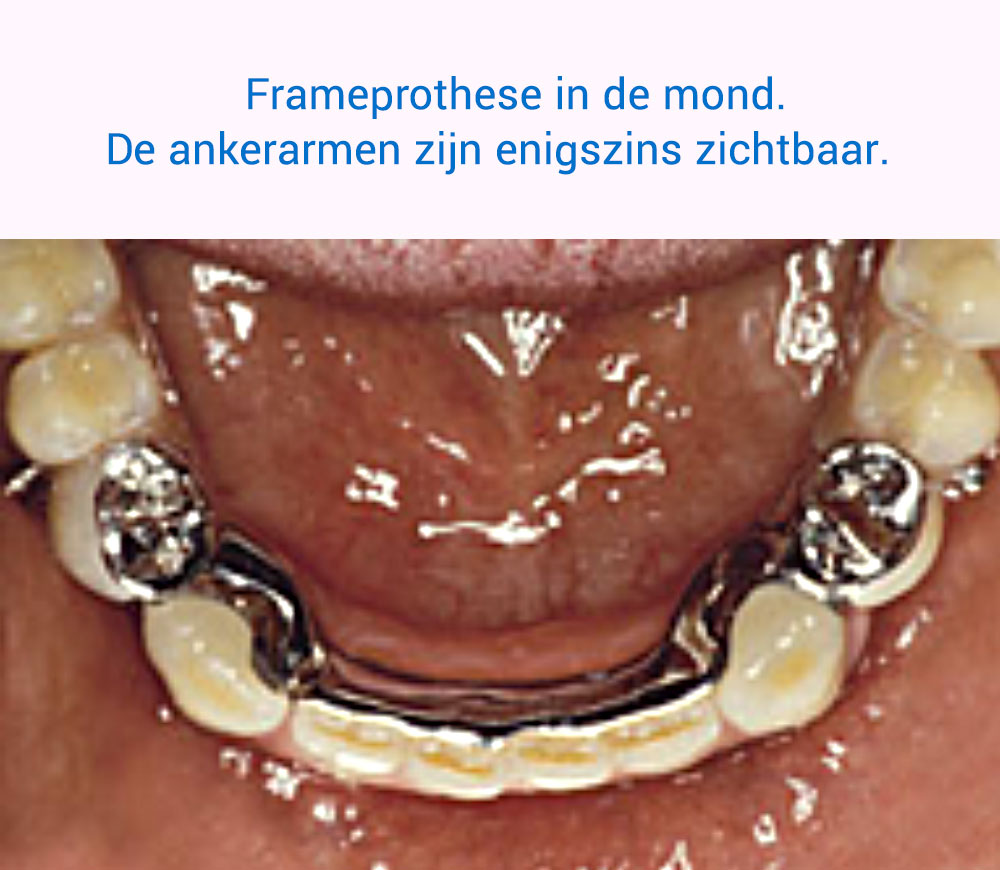 Frameprothese in de mond. De ankerarmen zijn enigszins zichtbaar.